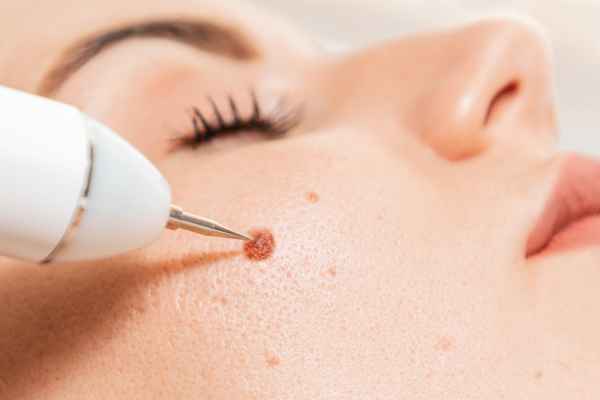 CryoPen: 5 Skin Concerns It May Be Used to Treat 3 What actually happens during a CryoPen treatment Clifton?