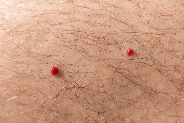 CryoPen: 5 Skin Concerns It May Be Used to Treat 2 cherry angioma removal Clifton