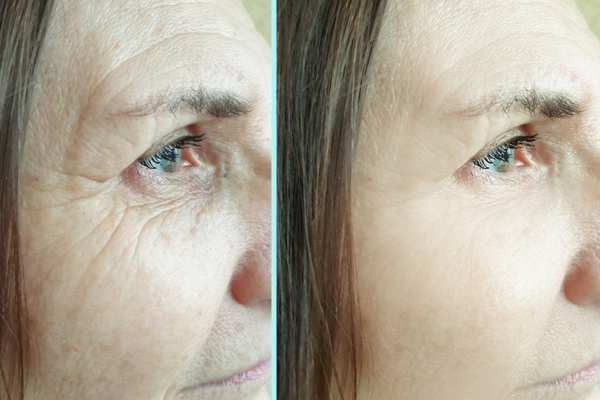 Why Do People Choose HIFU for a Non-Surgical Facelift? 4 How long can HIFU results last Clifton?