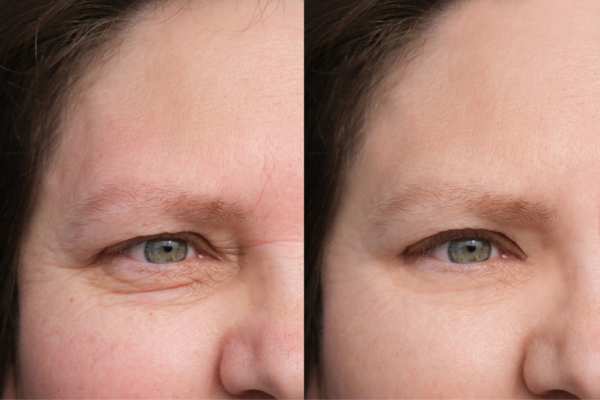 HIFU vs Botulinum Toxin: Understanding the Differences 4 How long do HIFU results last Clifton?