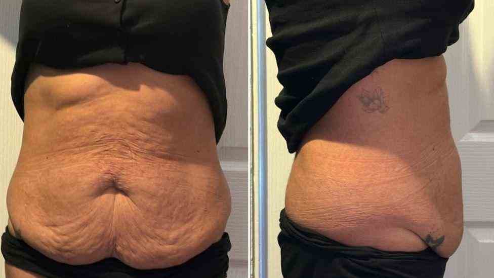 Lost the Weight but Not the Loose Skin? What You Should Know 1 Is It Definitely Loose Skin Clifton?